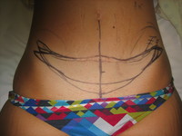 Before (Pre-Operative Markings)