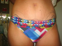 Before (Pre-Operative Markings)