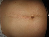 Abdominal scar pre-op
