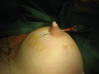 5. Cannula In Position