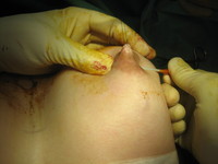 4. Cannula Passed Under Nipple