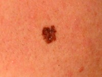 Close up melanoma left cheek