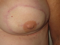 After (Final Post-Op Result)