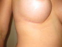 After (Right Breast Final Scar)