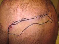 First stage scar excision