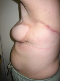After (Donor Site)