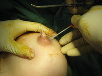 3. Intravenous Cannula Placed Under Nipple