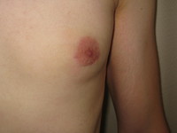 After (Left Breast Final Result)