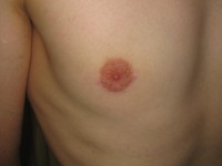 After (Right Breast Final Result)
