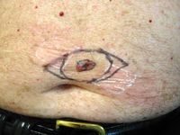 Melanoma central abdomen