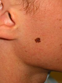 Melanoma left cheek