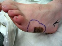 Melanoma left foot