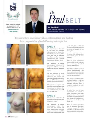 Nip Tuck Magazine July 2013 - Bilateral breast augmentation after childbearing and weight loss