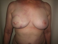 After Nipple Reconstruction