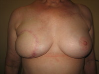 After (Before Nipple Reconstruction)