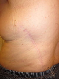 After (Donor Site)