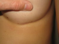 After (Left Breast Scar)