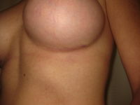 After (Left Breast Scar)