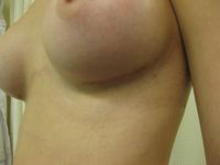 After (Left Breast Scar)