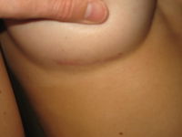 After (Right Breast Scar)