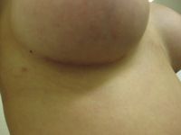 After (Right Breast Scar)