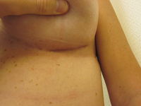 After (Left Breast Scar)