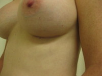 Post Operative Scar (Left Breast)