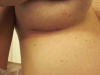 After (Right Breast Scar)