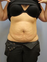 Belt Lipectomy, Gold Coast & Brisbane