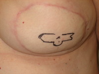 Before (Pre-Op Design)