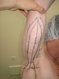 Before (Pre-Op Markings Right Arm)