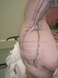 Before (Pre-Op Marking Right Chest)