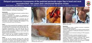 Delayed spontaneous myospasms of the pedicled pectoralis major flap in head and neck reconstruction