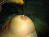 2. Traction Suture Placed to Evert Nipples